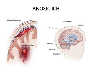 ANOXIC ICH
 