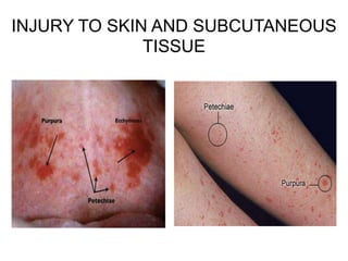 INJURY TO SKIN AND SUBCUTANEOUS
TISSUE
 