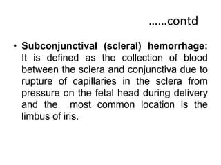 ……contd
• Subconjunctival (scleral) hemorrhage:
It is defined as the collection of blood
between the sclera and conjunctiva due to
rupture of capillaries in the sclera from
pressure on the fetal head during delivery
and the most common location is the
limbus of iris.
 