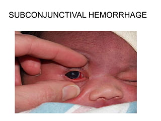 SUBCONJUNCTIVAL HEMORRHAGE
 