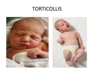 TORTICOLLIS
 