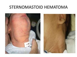 STERNOMASTOID HEMATOMA
 