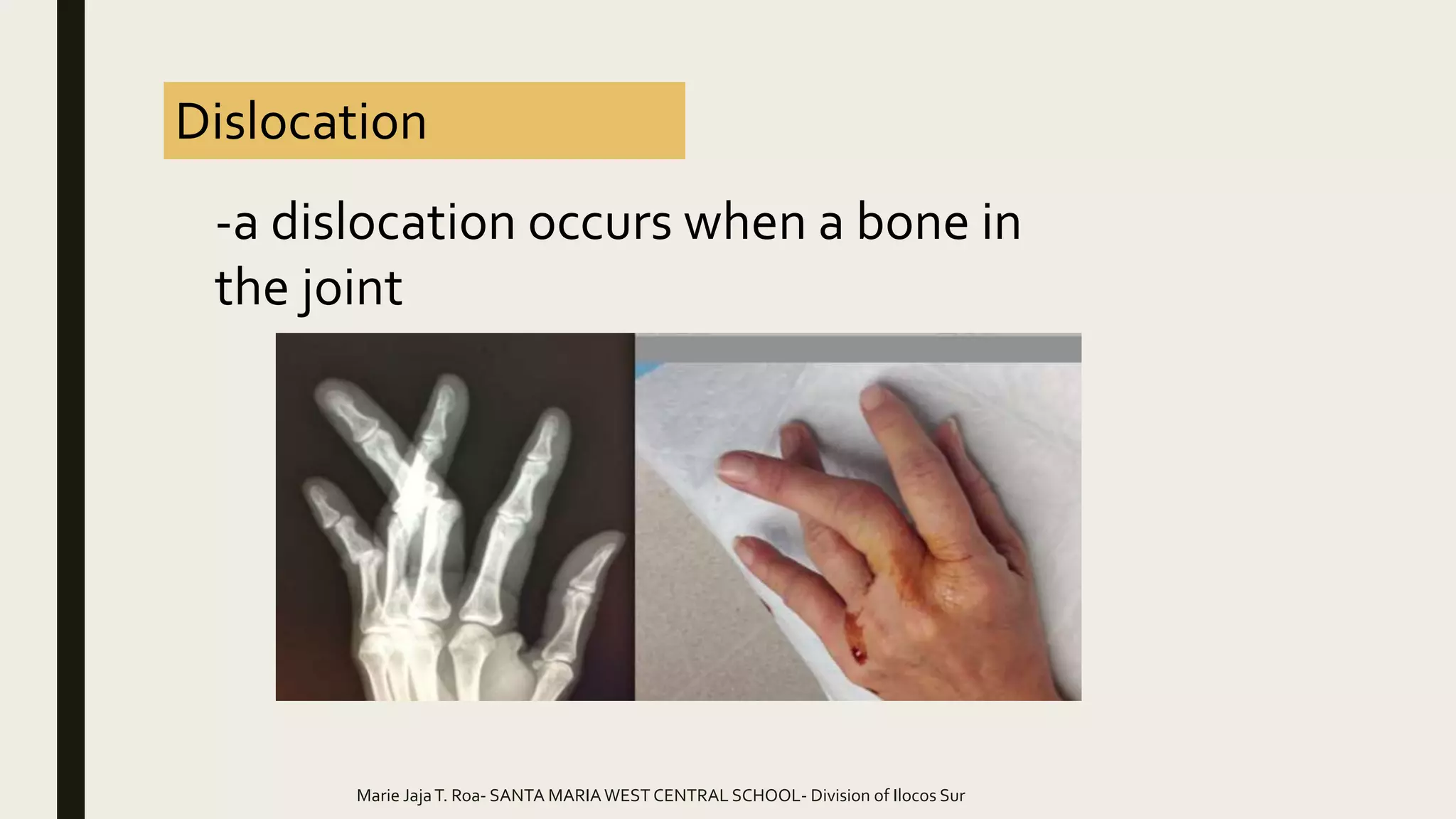 Common Bone and Muscle Injuries | PPTX