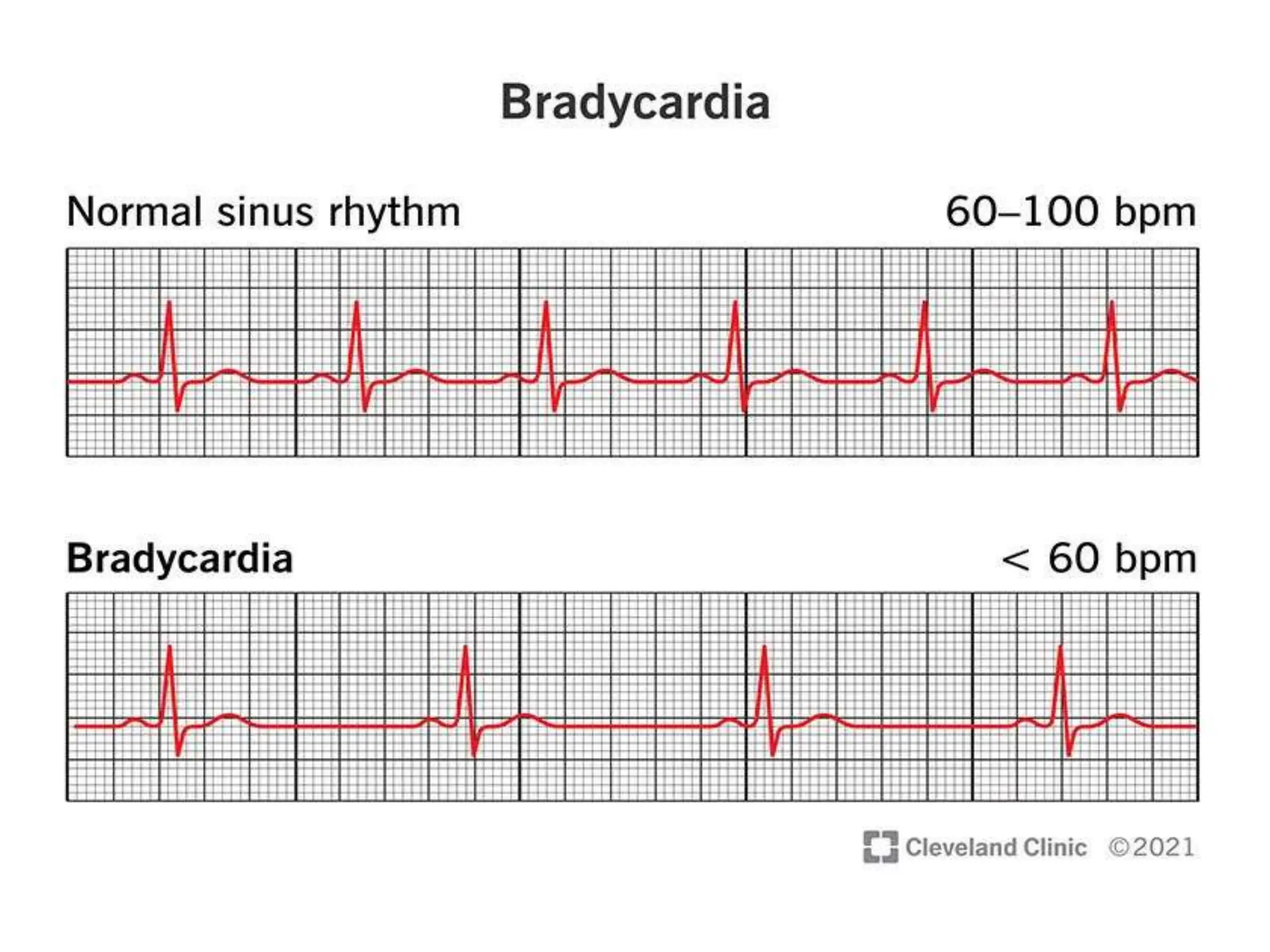 Common Cardios common cardiac arrhythmias.ppsx