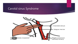 Carotid sinus Syndrome
 