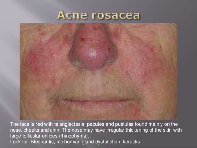 Rosacea - Derm101