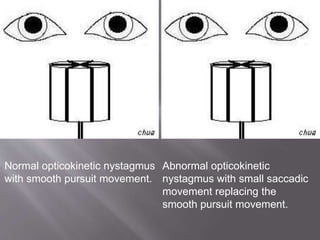Normal opticokinetic nystagmus
with smooth pursuit movement.
Abnormal opticokinetic
nystagmus with small saccadic
movement replacing the
smooth pursuit movement.
 