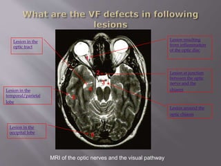 MRI of the optic nerves and the visual pathway
Lesion at junction
between the optic
nerve and the
chiasm
Lesion around the
optic chiasm
Lesion in the
optic tract
Lesion in the
temporal/parietal
lobe
Lesion in the
occipital lobe
Lesion resulting
from inflammation
of the optic disc
 