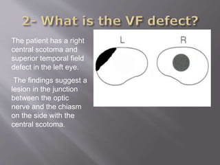 The patient has a right
central scotoma and
superior temporal field
defect in the left eye.
The findings suggest a
lesion in the junction
between the optic
nerve and the chiasm
on the side with the
central scotoma.
 