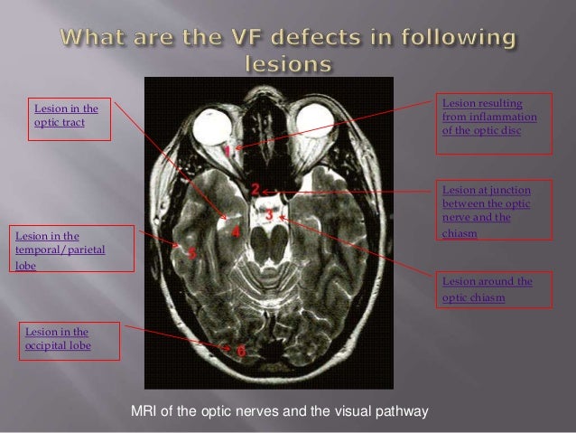 Common Cases: Neurological Visual Field defects
