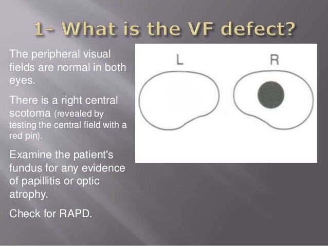 Common Cases: Neurological Visual Field defects