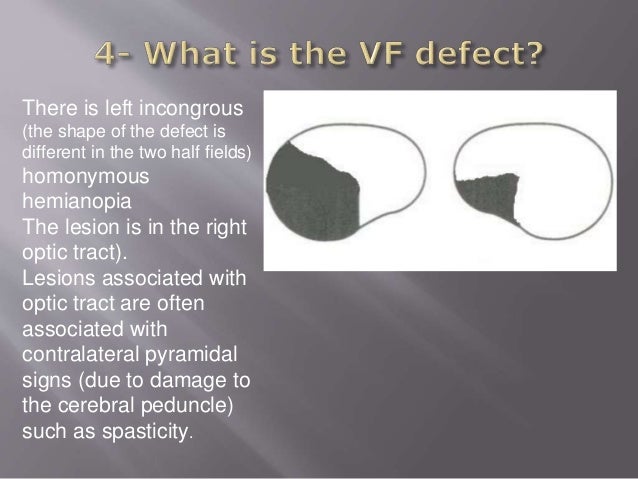 Common Cases: Neurological Visual Field defects