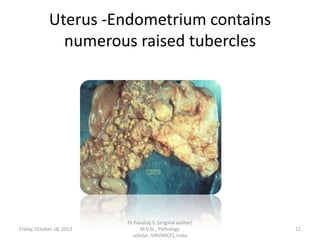 Uterus -Endometrium contains
numerous raised tubercles

Friday, October 18, 2013

Dr.Pavulraj.S, (original author)
M.V.Sc., Pathology
scholar, IVRI(NRCE), India

12

 