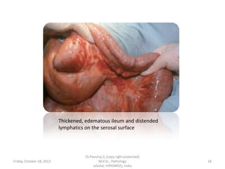 Thickened, edematous ileum and distended
lymphatics on the serosal surface

Friday, October 18, 2013

Dr.Pavulraj.S, (copy right protected)
M.V.Sc., Pathology
scholar, IVRI(NRCE), India

18

 