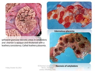 Edematous placenta

yellowish granular necrotic areas in cotyledons
and chorion is opaque and thickened with a
leathery consistency. Called leathery placenta.

Friday, October 18, 2013

Dr.Pavulraj.S, (original author)
Necrosis
M.V.Sc., Pathology
scholar, IVRI(NRCE), India

of cotyledons

24

 