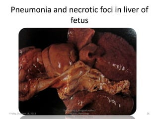 Pneumonia and necrotic foci in liver of
fetus

Friday, October 18, 2013

Dr.Pavulraj.S, (original author)
M.V.Sc., Pathology
scholar, IVRI(NRCE), India

26

 