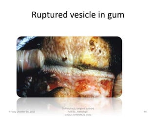 Ruptured vesicle in gum

Friday, October 18, 2013

Dr.Pavulraj.S, (original author)
M.V.Sc., Pathology
scholar, IVRI(NRCE), India

46

 