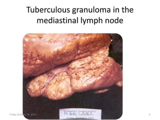 Tuberculous granuloma in the
mediastinal lymph node

Friday, October 18, 2013

Dr.Pavulraj.S, (original author)
M.V.Sc., Pathology
scholar, IVRI(NRCE), India

6

 