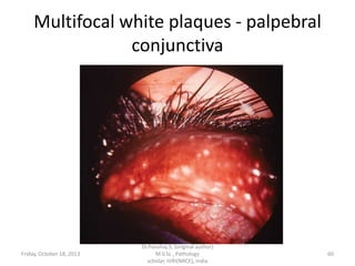 Multifocal white plaques - palpebral
conjunctiva

Friday, October 18, 2013

Dr.Pavulraj.S, (original author)
M.V.Sc., Pathology
scholar, IVRI(NRCE), India

60

 