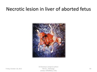 Necrotic lesion in liver of aborted fetus

Friday, October 18, 2013

Dr.Pavulraj.S, (original author)
M.V.Sc., Pathology
scholar, IVRI(NRCE), India

64

 