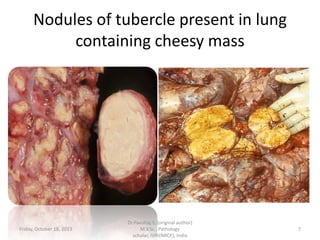 Nodules of tubercle present in lung
containing cheesy mass

Friday, October 18, 2013

Dr.Pavulraj.S, (original author)
M.V.Sc., Pathology
scholar, IVRI(NRCE), India

7

 