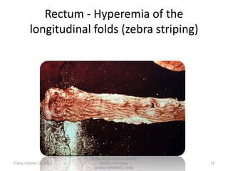 Rectum - Hyperemia of the
longitudinal folds (zebra striping)

Friday, October 18, 2013

Dr.Pavulraj.S, (original author)
M.V.Sc., Pathology
scholar, IVRI(NRCE), India

73

 
