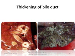 Thickening of bile duct

Friday, October 18, 2013

Dr.Pavulraj.S, (original author) M.V.Sc.,
Pathology scholar, IVRI(NRCE), India

87

 