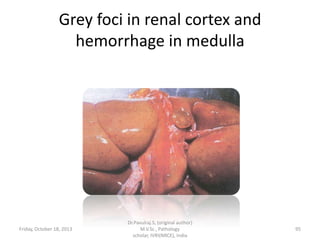 Grey foci in renal cortex and
hemorrhage in medulla

Friday, October 18, 2013

Dr.Pavulraj.S, (original author)
M.V.Sc., Pathology
scholar, IVRI(NRCE), India

95

 