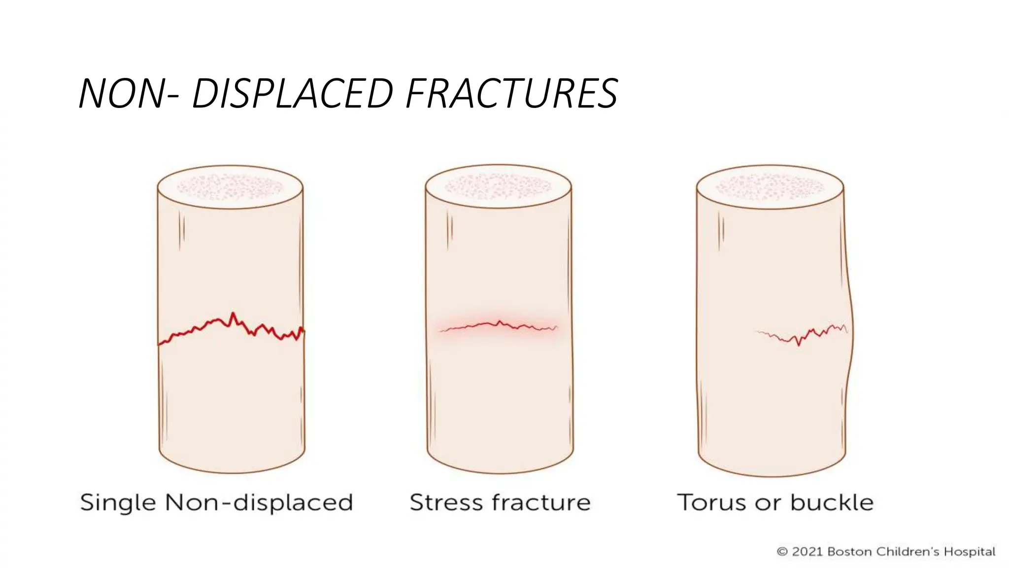 COMMON CHILDHOOD FRACTURES. .pptx