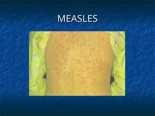 Measles Rash Vs Strep Rash common childhood infections and rashes (1).ppt