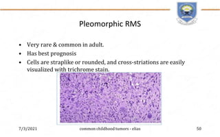 Pleomorphic Rms Common childhood ophthalmic malignancy - Dr Elias | PPTX