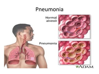 Pneumonia
• Infection of the lungs where in air sacs are
filled with fluid which limits oxygen intake.
• Signs & Symptoms: Chills, High fever, Chest
pain by deep inspiration, cough, crackles and
wheezes heard on breathing sounds.
• Treatment: antibiotics; Hospitalization in
severe cases or in infants.
 