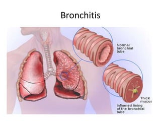 Bronchitis
• Inflammation of the Bronchial tubes ( the air
passages between nose and lungs).
• Signs & Symptoms: Cough lasting for weeks,
wheezing, chest pain, low fever and chills,
sore throat, body ache, blocked nose.
• Treatment: Take a rest, drink fluids, breath
warm and moist air, medications for
cough/pain, antibiotics for bacterial infection.
 