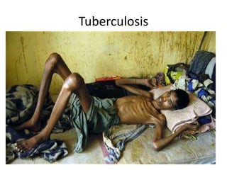 Tuberculosis
• An infection bacterial disease that commonly
affects the lungs.
• Signs & Symptoms: Cough (worse in the
morning, lasts 3 weeks or more, w/ blood),
chest pain, breathlessness, night sweats,
pneumonia, weight loss, fatigue.
• Treatment: Standard Six-month course of four
antibiotics.
 