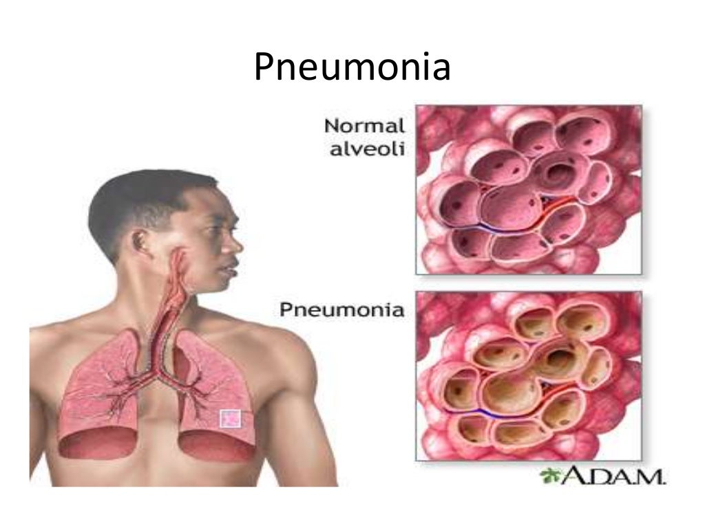 Common communicable diseases and its prevention