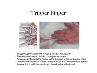 Trigger Finger Injection Protocol Common conditions of the hand (2013) | PPT