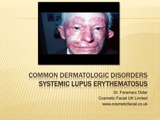 COMMON DERMATOLOGIC DISORDERS
SYSTEMIC LUPUS ERYTHEMATOSUS
Dr. Faramarz Didar
Cosmetic Facial UK Limited
www.cosmeticfacial.co.uk
 
