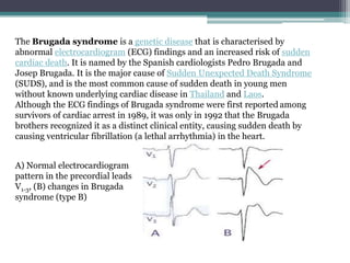 The Brugada syndrome is a genetic disease that is characterised by
abnormal electrocardiogram (ECG) findings and an increased risk of sudden
cardiac death. It is named by the Spanish cardiologists Pedro Brugada and
Josep Brugada. It is the major cause of Sudden Unexpected Death Syndrome
(SUDS), and is the most common cause of sudden death in young men
without known underlying cardiac disease in Thailand and Laos.
Although the ECG findings of Brugada syndrome were first reported among
survivors of cardiac arrest in 1989, it was only in 1992 that the Brugada
brothers recognized it as a distinct clinical entity, causing sudden death by
causing ventricular fibrillation (a lethal arrhythmia) in the heart.


A) Normal electrocardiogram
pattern in the precordial leads
V1-3, (B) changes in Brugada
syndrome (type B)
 