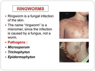  Ringworm is a fungal infection
of the skin.
 The name “ringworm” is a
misnomer, since the infection
is caused by a fungus, not a
worm.
 Pathogens :
 Microsporum
 Trichophyton
 Epidermophyton
 