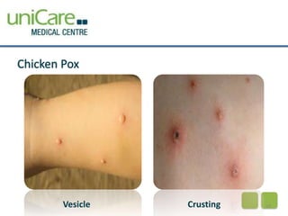 Chicken Pox 
Vesicle Crusting 18 
 