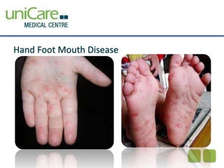 Hand Foot Mouth Disease 
22 
 