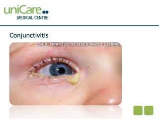 Conjunctivitis 
23 
 