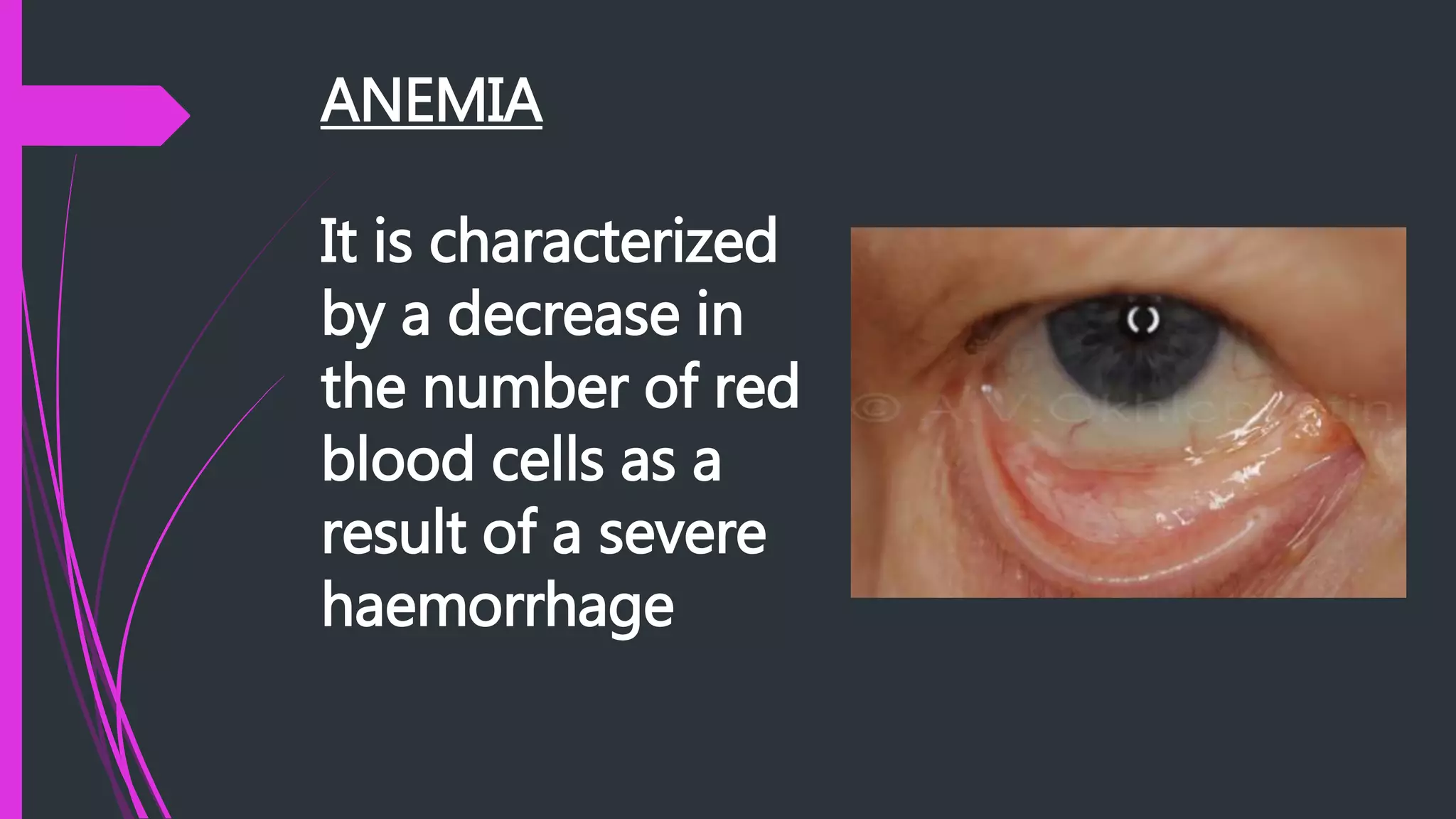 ANEMIA
It is characterized
by a decrease in
the number of red
blood cells as a
result of a severe
haemorrhage
 