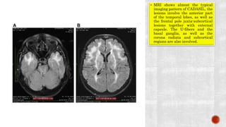 Common disorders misdiagnosed as ms | PPTX