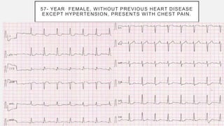 57- YEAR FEMALE, WITHOUT PREVIOUS HEART DISEASE
EXCEPT HYPERTENSION, PRESENTS WITH CHEST PAIN.
 
