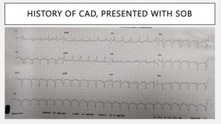 HISTORY OF CAD, PRESENTED WITH SOB
 
