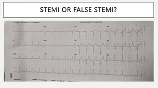 STEMI OR FALSE STEMI?
 