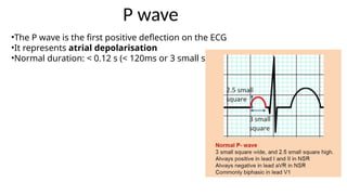 Positive Deflection common ecgs appraoch-1.pptx mbbs final year | PPTX