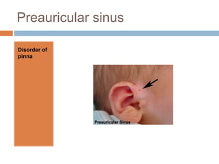 Pinna Sinus Common ent disorders | PPTX