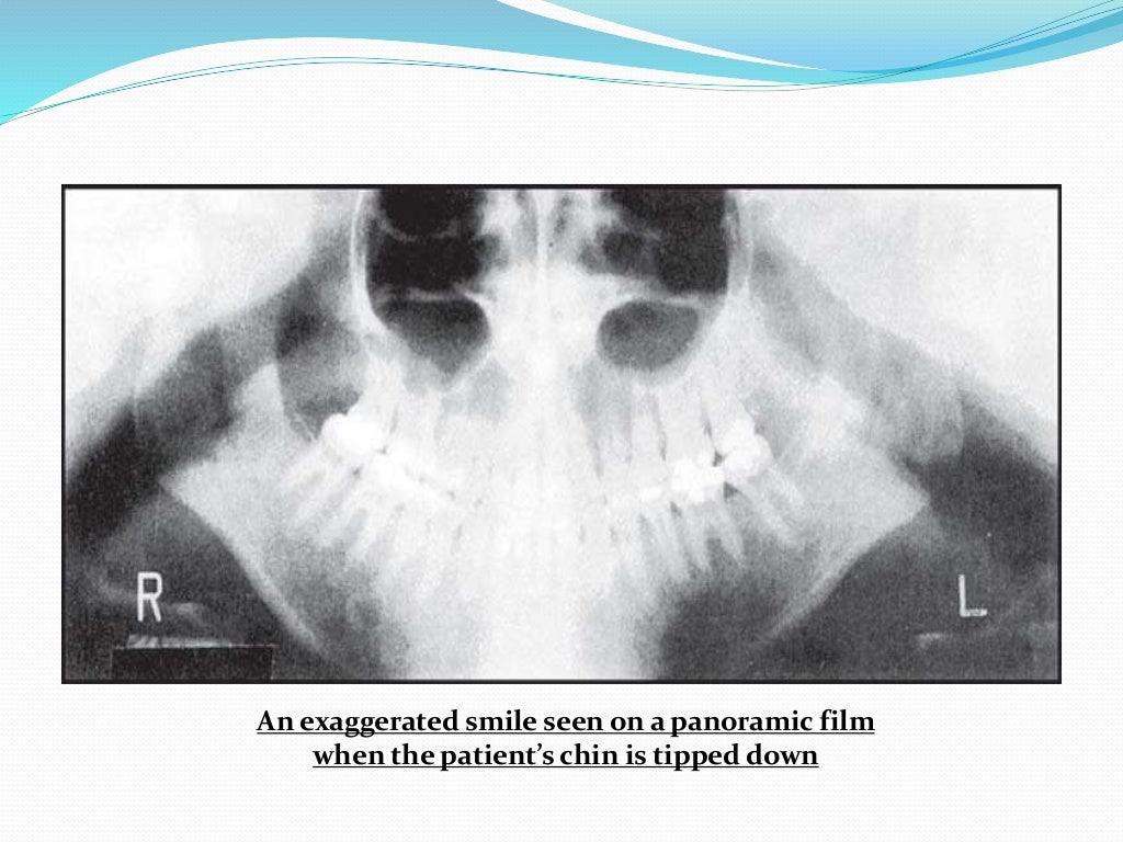 Common errors in opg